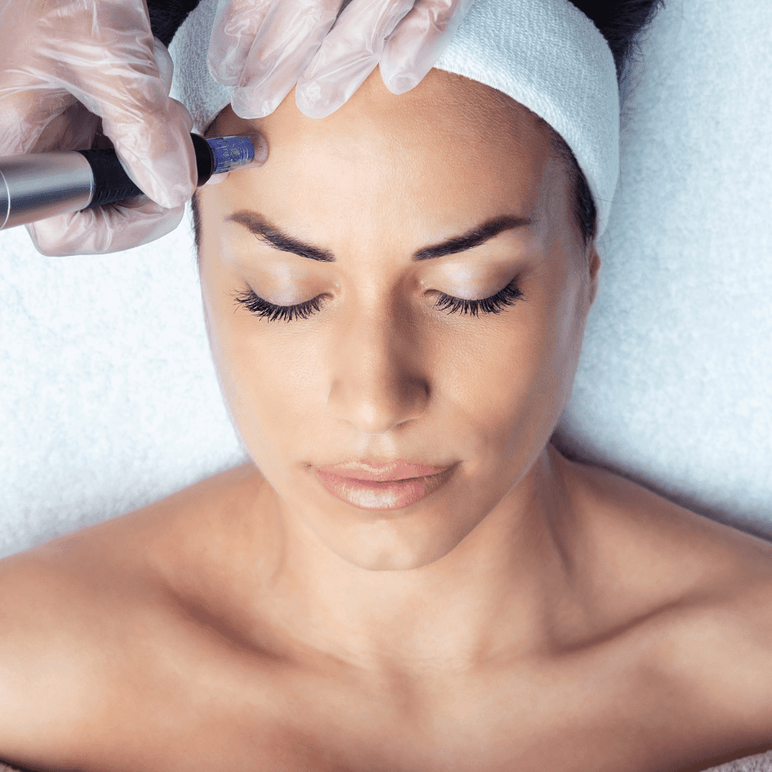 Microneedling (Dermapen), Θεραπεία για Φυσική Αναγέννηση του Δέρματος