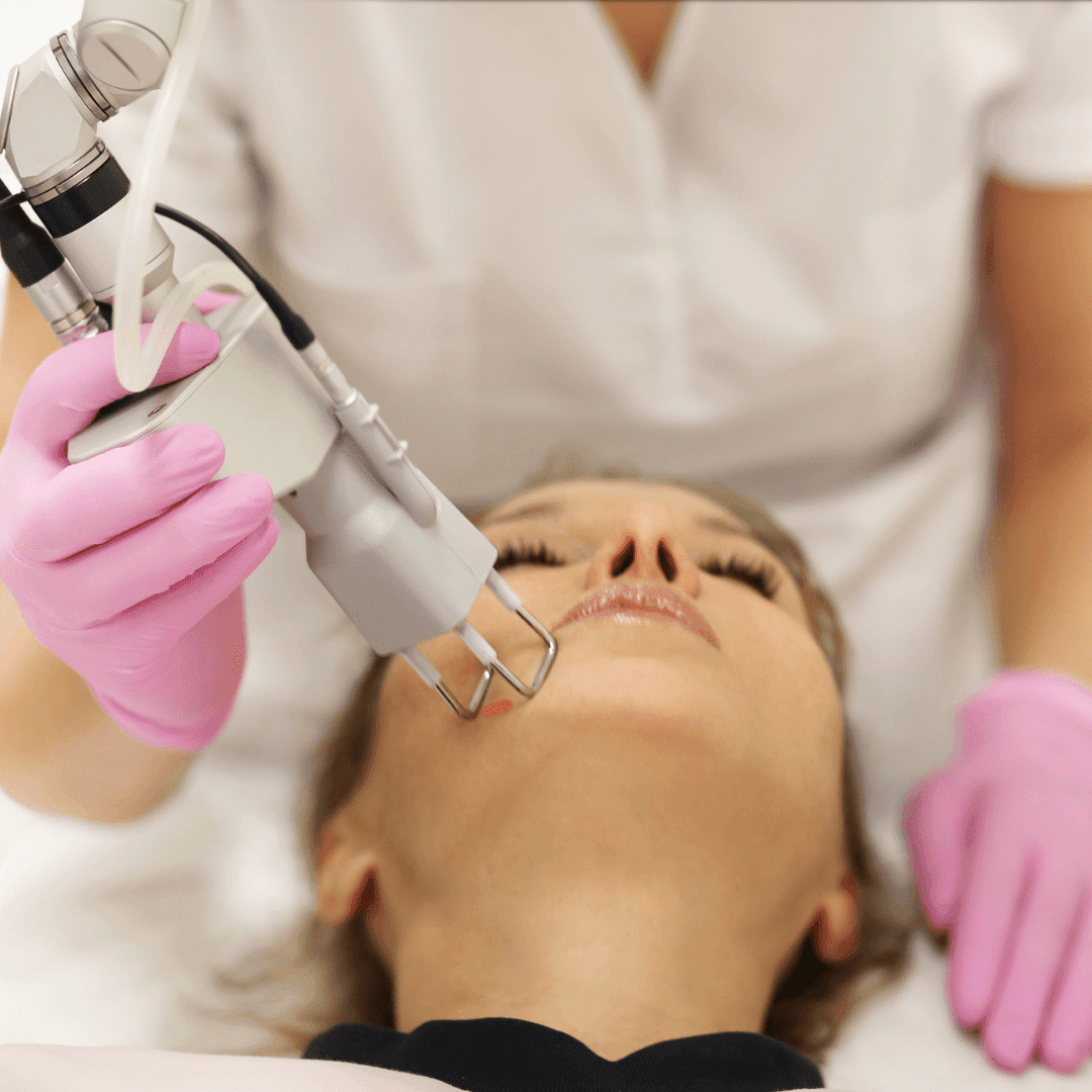Γυναίκα σε συνεδρία laser αποτρίχωσης στο πρόσωπο