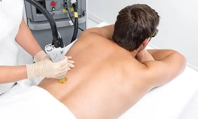 Θεραπεία laser αποτρίχωσης